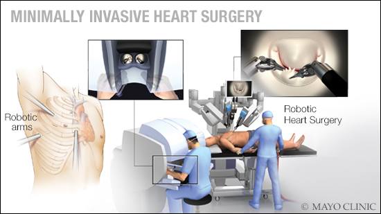 Heart Surgery